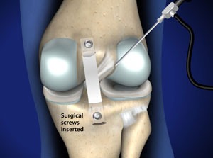 knee pcl