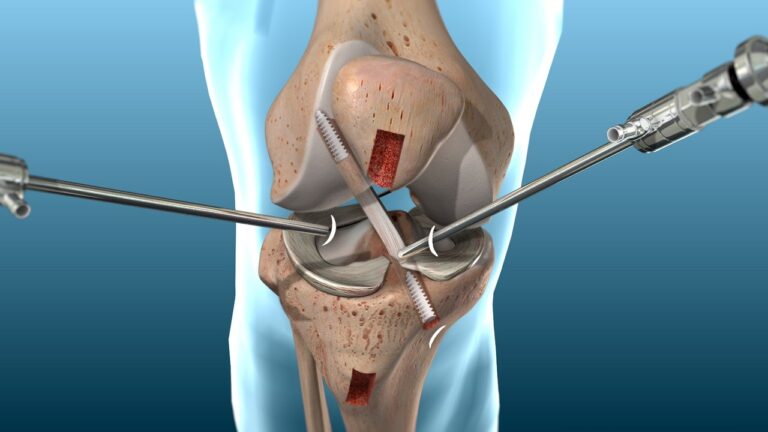 knee acl