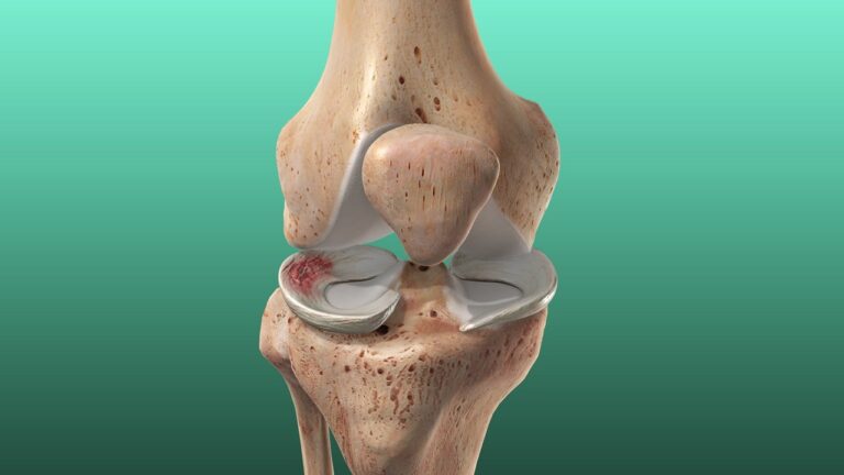 meniscus tear